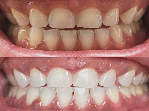 Smile Perfected Whitening Results