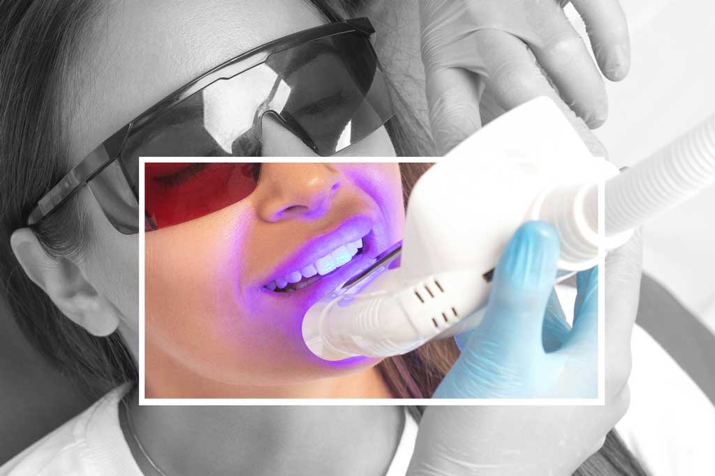 zoom whitening