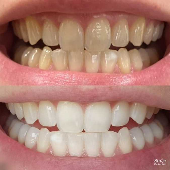 Smile Perfected Before and after - 1