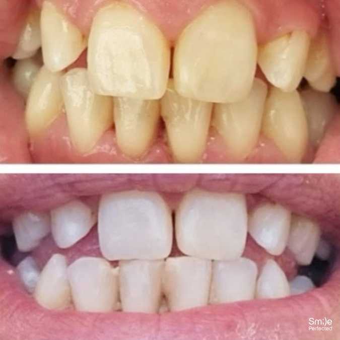 Smile Perfected Before and after - 2