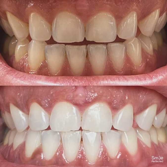 Smile Perfected Before and after - 3
