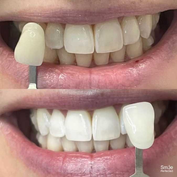 Smile Perfected Before and after - 4