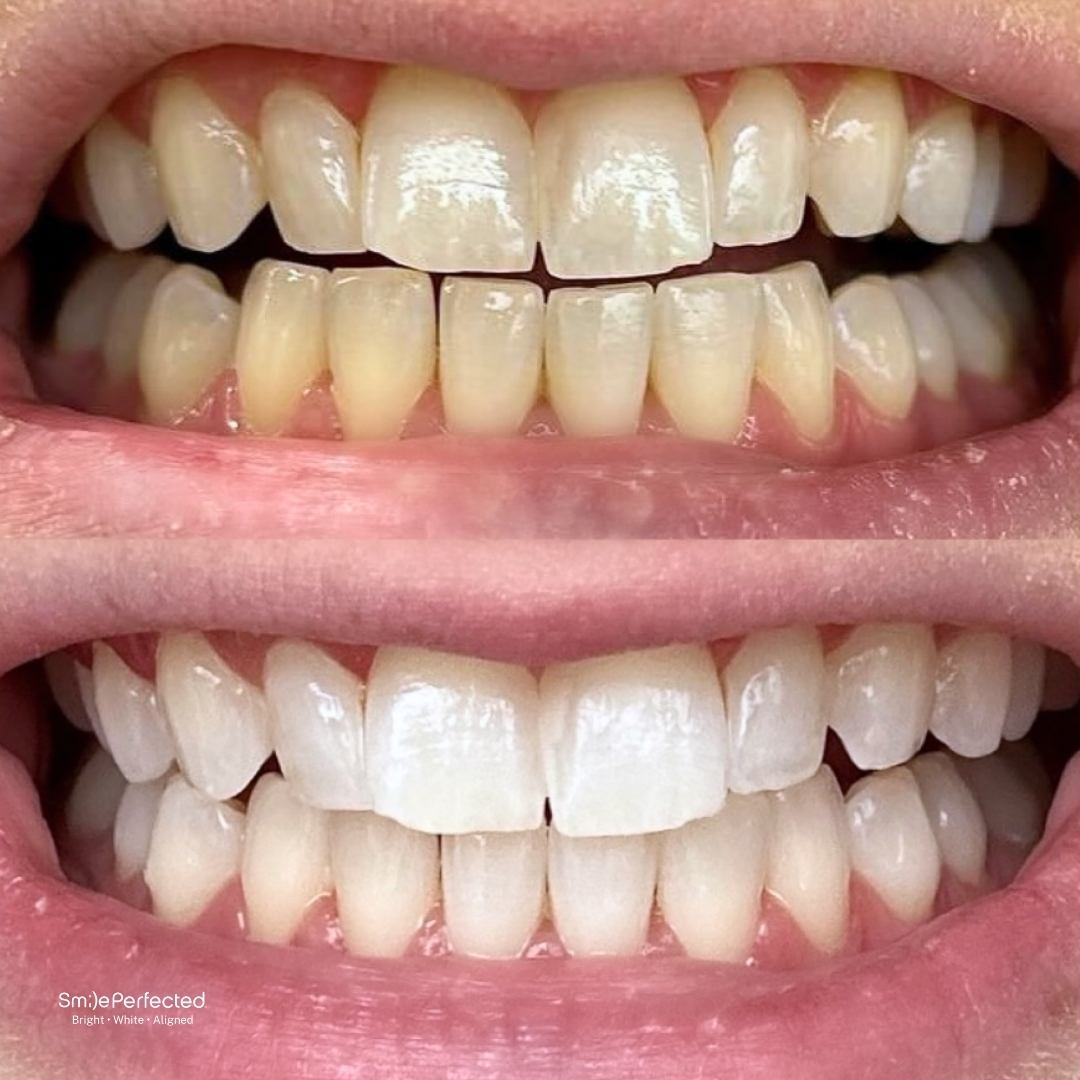 clear aligner safe whitening